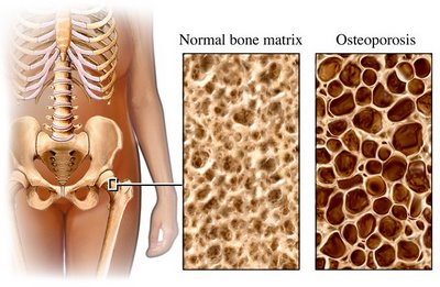 http://myhealing.files.wordpress.com/2008/04/osteoporosis.jpg?w=400&amp;h=261
